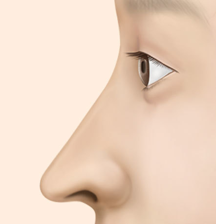 韓国整形NANA美容外科 スリムライン鼻整形
