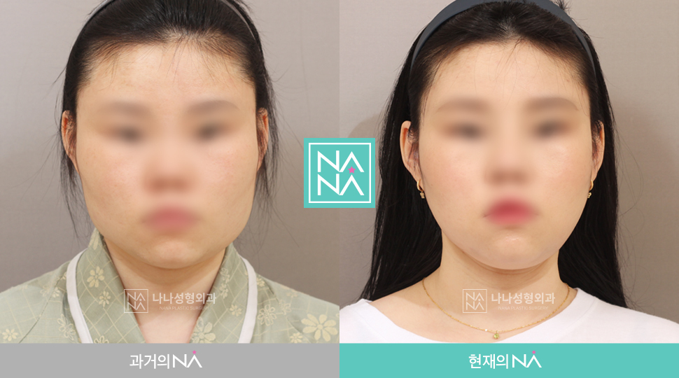 韓国nana美容整形外科 症例写真